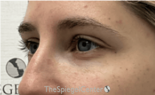 Tear Trough / Under Eye Fillers Before & After Gallery - Patient 383715 - Image 4