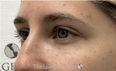 Tear Trough / Under Eye Fillers Before & After Gallery - Patient 383715 - Image 4