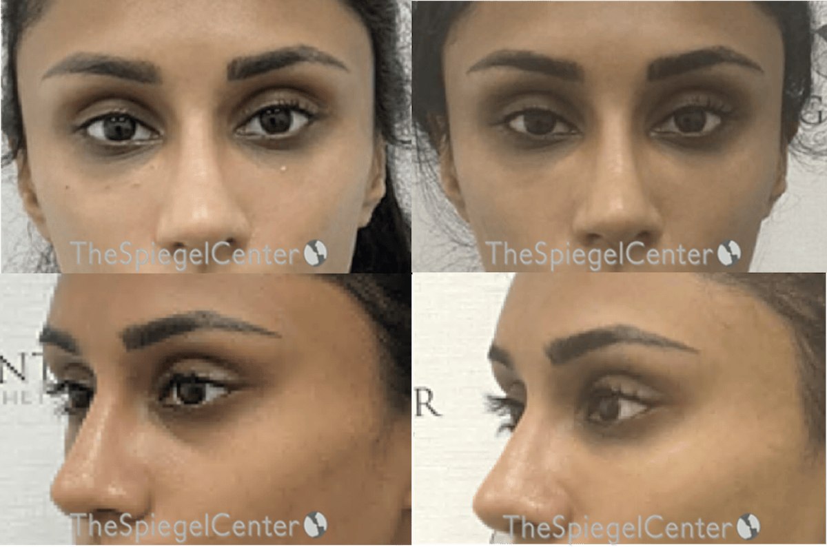 Tear Trough / Under Eye Fillers Before & After Gallery - Patient 139330 - Image 1
