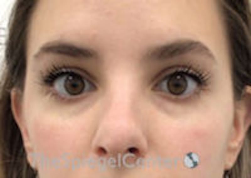 Tear Trough / Under Eye Fillers Before & After Gallery - Patient 357851 - Image 1