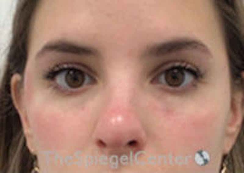 Tear Trough / Under Eye Fillers Before & After Gallery - Patient 357851 - Image 2