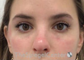Tear Trough / Under Eye Fillers Before & After Gallery - Patient 357851 - Image 2