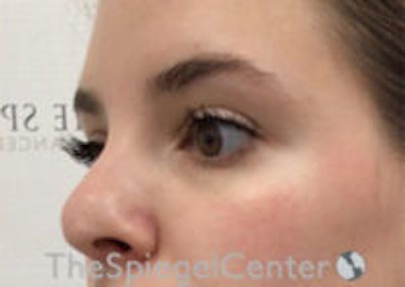 Tear Trough / Under Eye Fillers Before & After Gallery - Patient 357851 - Image 3