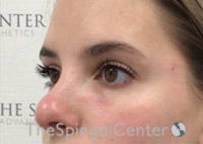 Tear Trough / Under Eye Fillers Before & After Gallery - Patient 357851 - Image 4