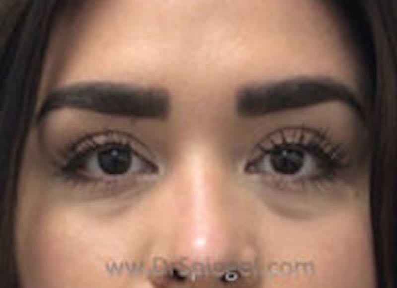 Tear Trough / Under Eye Fillers Before & After Gallery - Patient 187756 - Image 1