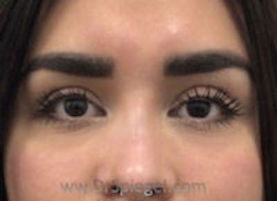 Tear Trough / Under Eye Fillers Before & After Gallery - Patient 187756 - Image 2