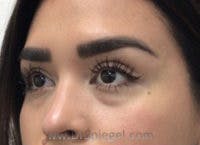 Tear Trough / Under Eye Fillers Before & After Gallery - Patient 187756 - Image 3