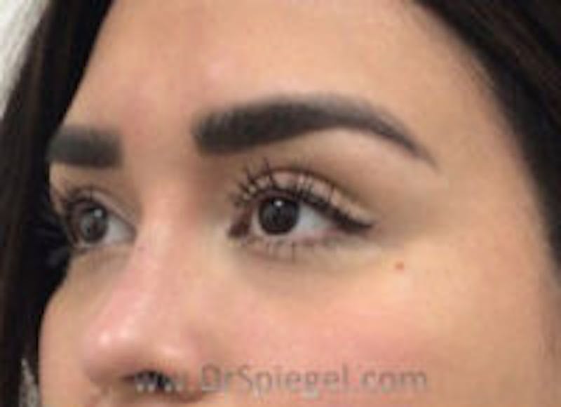 Tear Trough / Under Eye Fillers Before & After Gallery - Patient 187756 - Image 4