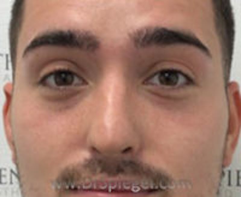 Tear Trough / Under Eye Fillers Before & After Gallery - Patient 184032 - Image 1