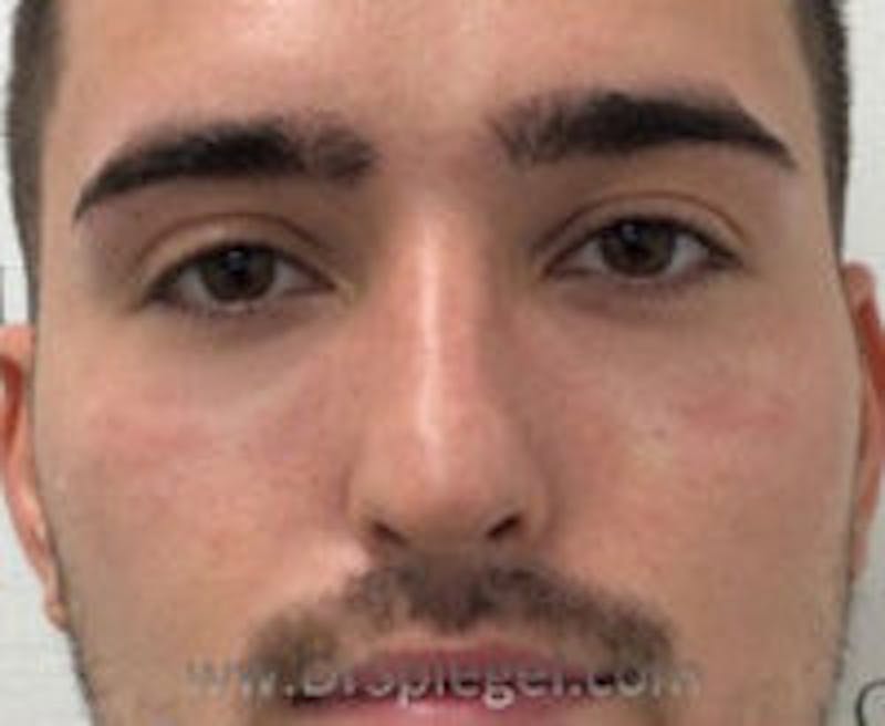 Tear Trough / Under Eye Fillers Before & After Gallery - Patient 184032 - Image 2