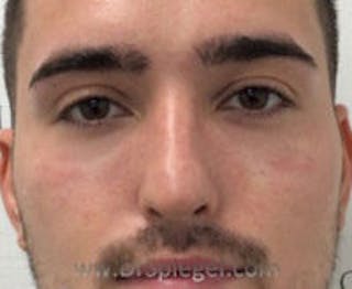 Tear Trough / Under Eye Fillers Before & After Gallery - Patient 184032 - Image 2