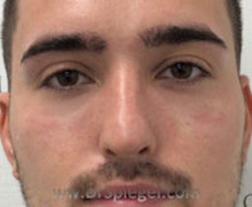 Tear Trough / Under Eye Fillers Before & After Gallery - Patient 184032 - Image 2