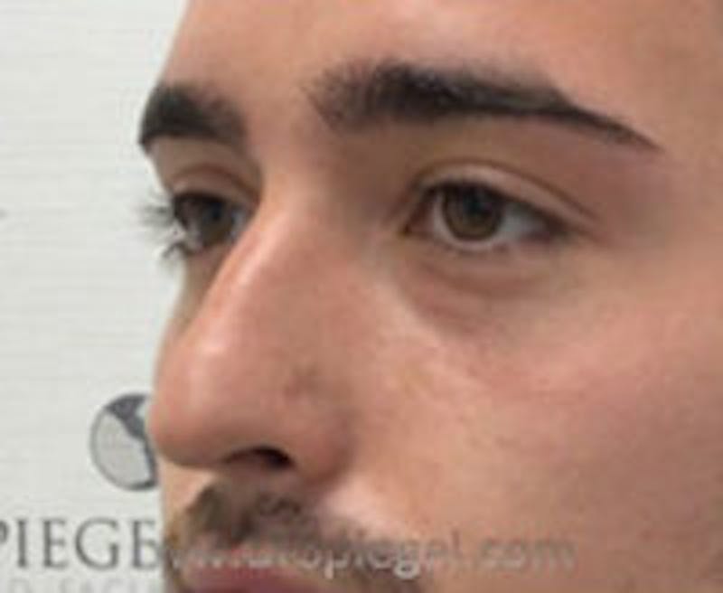 Tear Trough / Under Eye Fillers Before & After Gallery - Patient 184032 - Image 3