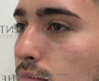 Tear Trough / Under Eye Fillers Before & After Gallery - Patient 184032 - Image 4