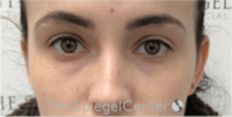 Tear Trough / Under Eye Fillers Before & After Gallery - Patient 196865 - Image 1