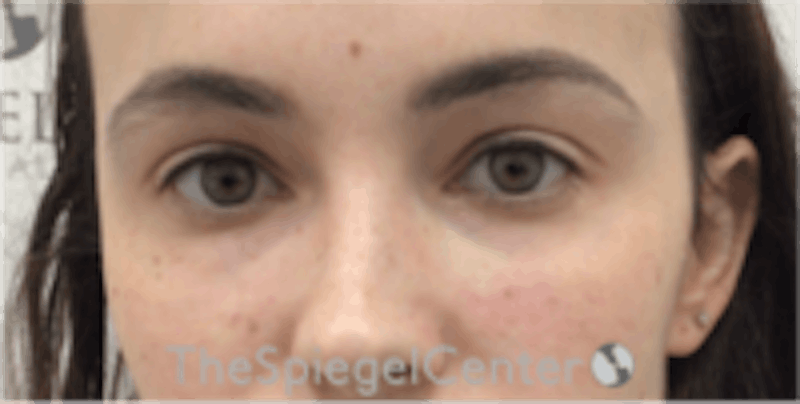 Tear Trough / Under Eye Fillers Before & After Gallery - Patient 196865 - Image 2