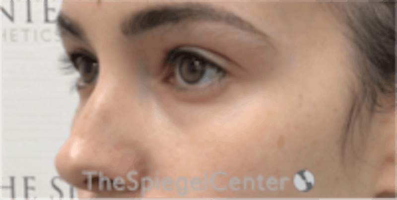Tear Trough / Under Eye Fillers Before & After Gallery - Patient 196865 - Image 3