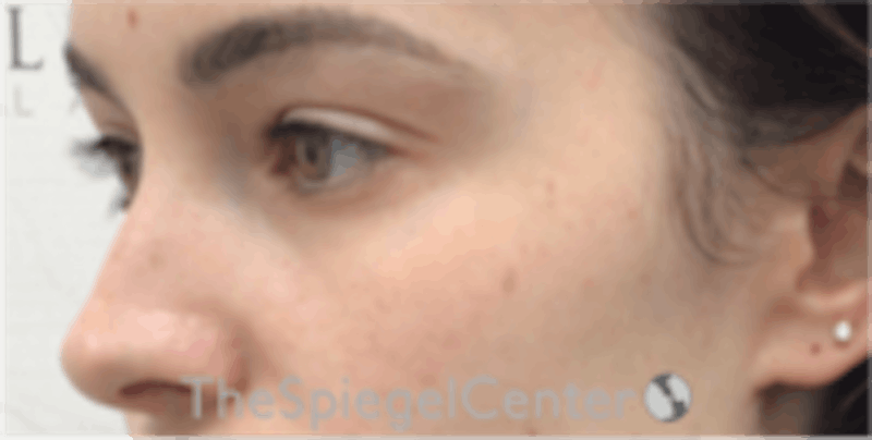 Tear Trough / Under Eye Fillers Before & After Gallery - Patient 196865 - Image 4