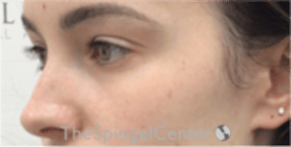 Tear Trough / Under Eye Fillers Before & After Gallery - Patient 196865 - Image 4
