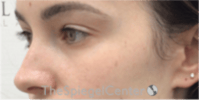 Tear Trough / Under Eye Fillers Before & After Gallery - Patient 196865 - Image 4