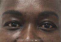 Tear Trough / Under Eye Fillers Before & After Gallery - Patient 358813 - Image 2