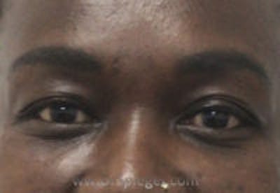 Tear Trough / Under Eye Fillers Before & After Gallery - Patient 358813 - Image 2