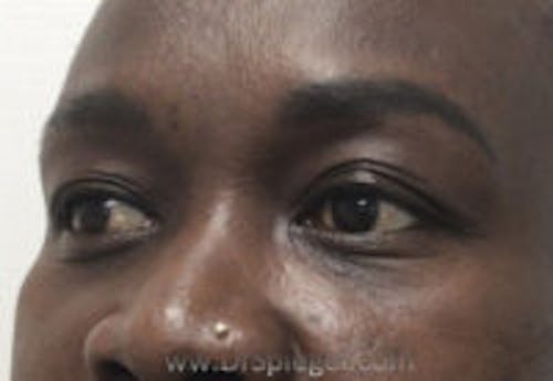 Tear Trough / Under Eye Fillers Before & After Gallery - Patient 358813 - Image 3