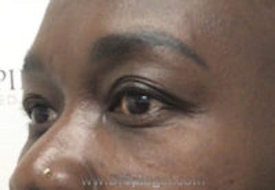Tear Trough / Under Eye Fillers Before & After Gallery - Patient 358813 - Image 4