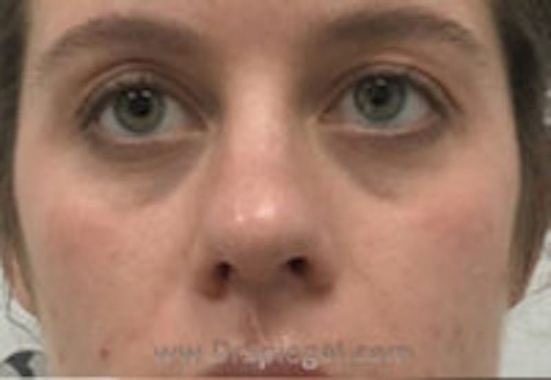 Tear Trough / Under Eye Fillers Before & After Gallery - Patient 334817 - Image 1