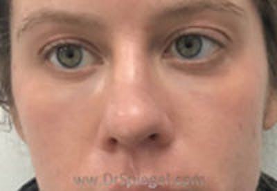 Tear Trough / Under Eye Fillers Before & After Gallery - Patient 334817 - Image 2