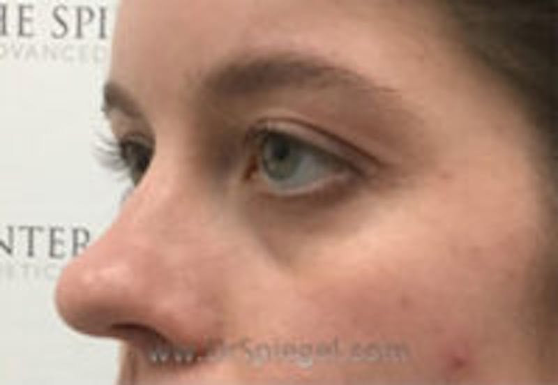 Tear Trough / Under Eye Fillers Before & After Gallery - Patient 334817 - Image 3