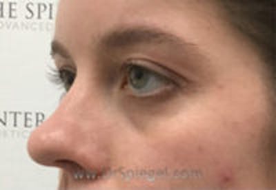 Tear Trough / Under Eye Fillers Before & After Gallery - Patient 334817 - Image 3