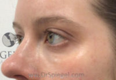 Tear Trough / Under Eye Fillers Before & After Gallery - Patient 334817 - Image 4
