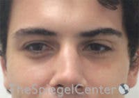Tear Trough / Under Eye Fillers Before & After Gallery - Patient 314581 - Image 1