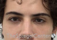 Tear Trough / Under Eye Fillers Before & After Gallery - Patient 314581 - Image 2