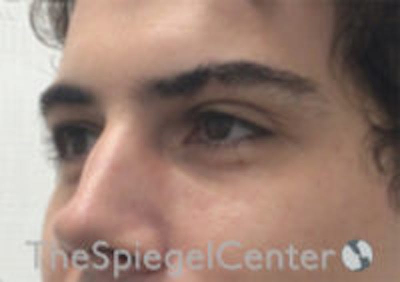 Tear Trough / Under Eye Fillers Before & After Gallery - Patient 314581 - Image 3
