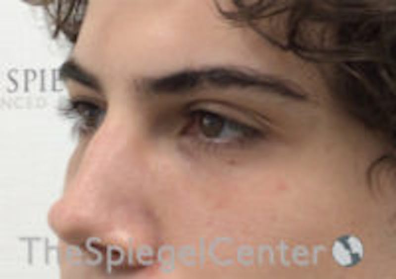 Tear Trough / Under Eye Fillers Before & After Gallery - Patient 314581 - Image 4