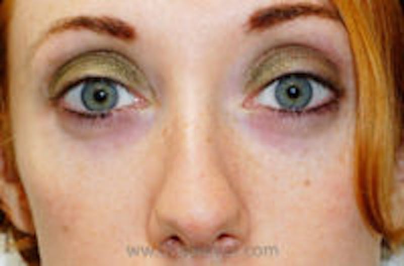 Tear Trough / Under Eye Fillers Before & After Gallery - Patient 113968 - Image 1