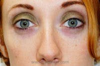 Tear Trough / Under Eye Fillers Before & After Gallery - Patient 113968 - Image 1
