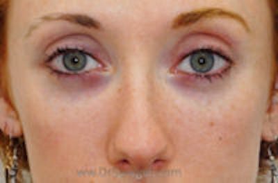 Tear Trough / Under Eye Fillers Before & After Gallery - Patient 113968 - Image 2