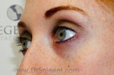 Tear Trough / Under Eye Fillers Before & After Gallery - Patient 113968 - Image 3