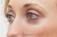Tear Trough / Under Eye Fillers Before & After Gallery - Patient 113968 - Image 4