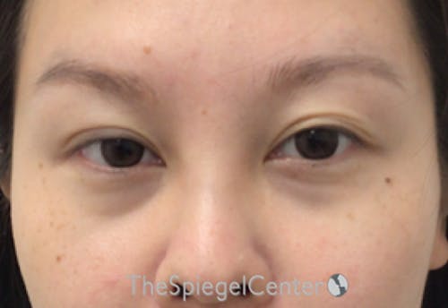 Tear Trough / Under Eye Fillers Before & After Gallery - Patient 994536 - Image 1