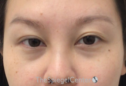 Tear Trough / Under Eye Fillers Before & After Gallery - Patient 994536 - Image 1