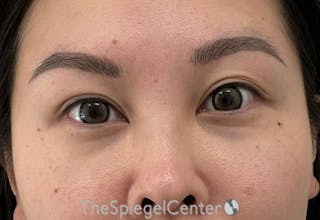 Tear Trough / Under Eye Fillers Before & After Gallery - Patient 994536 - Image 2