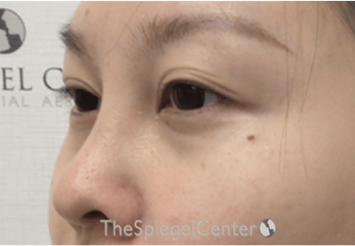 Tear Trough / Under Eye Fillers Before & After Gallery - Patient 994536 - Image 3