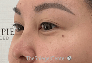 Tear Trough / Under Eye Fillers Before & After Gallery - Patient 994536 - Image 4