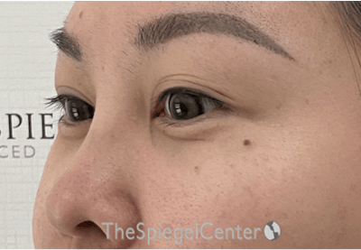 Tear Trough / Under Eye Fillers Before & After Gallery - Patient 994536 - Image 4