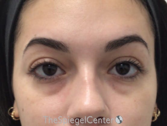 Tear Trough / Under Eye Fillers Before & After Gallery - Patient 189271 - Image 1