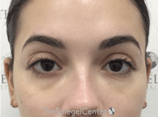Tear Trough / Under Eye Fillers Before & After Gallery - Patient 189271 - Image 2